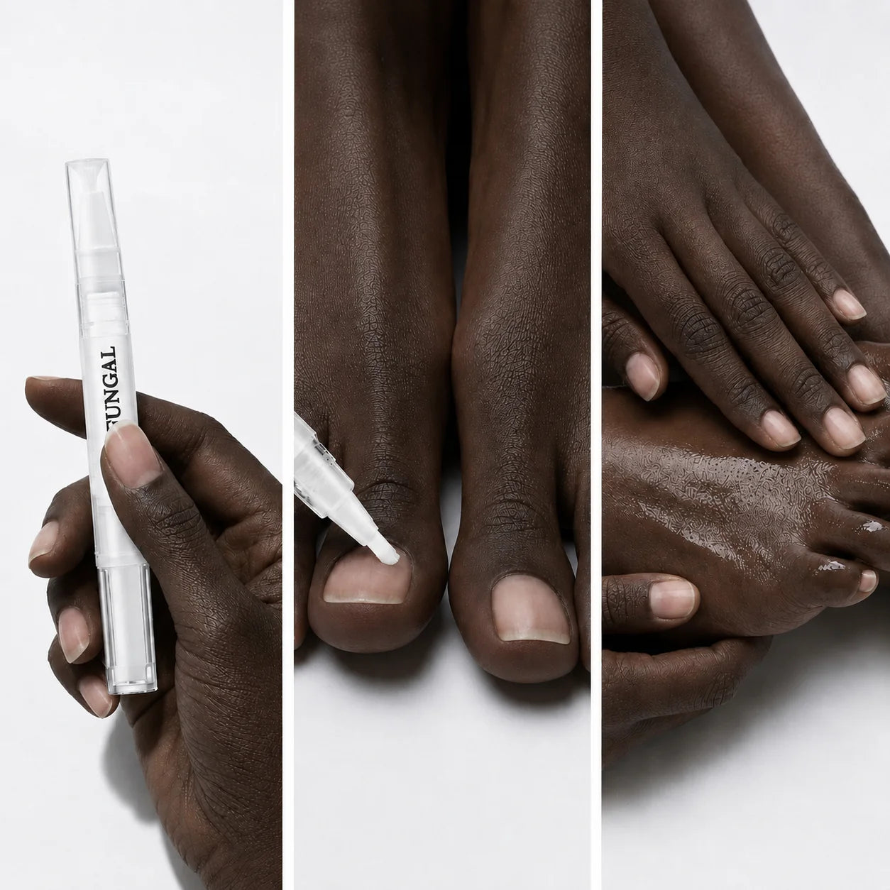Stylo Antifongique NailCare™ : Des ongles sains en quelques jours