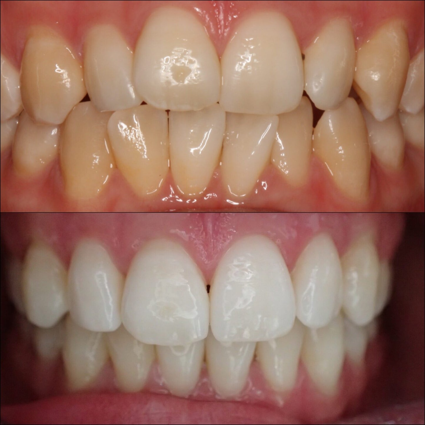 Blanchisseur de Dents - Brillant White - 100 % Naturelle et Efficace - NJ Market