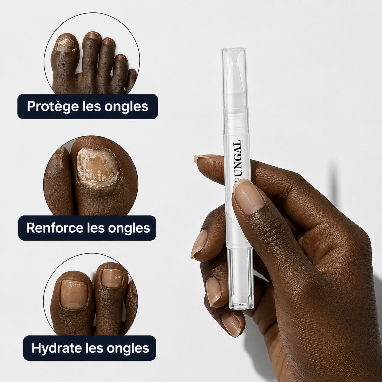 Stylo Antifongique NailCare™ : Des ongles sains en quelques jours