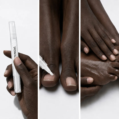Stylo Antifongique NailCare™ : Des ongles sains en quelques jours